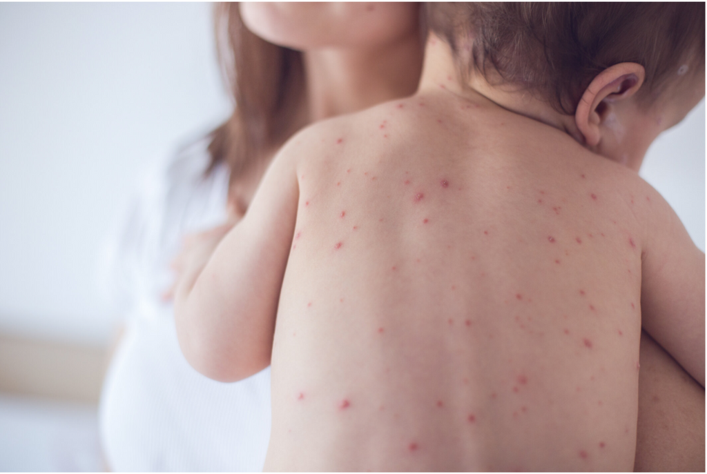 All Natural Relief for Shingles and Chickenpox